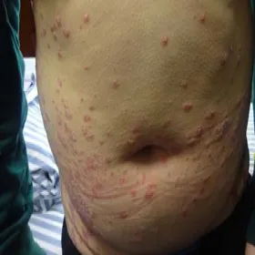 choroba łuszczyca zdjęcia