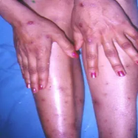 choroba Adamantiadesa-Behçeta