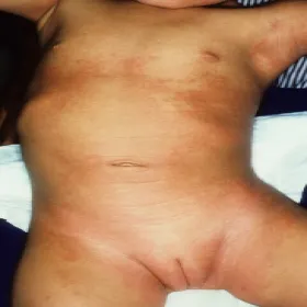 choroba Kawasakiego u dziecka