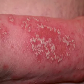 choroba Sneddona i Wilkinsona