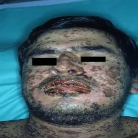 choroba Stevensa-Johnsona