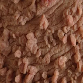 choroba skóry włókniaki