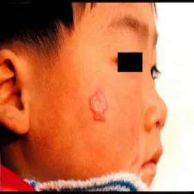 choroba sporotrychoza u dziecka na twarzy