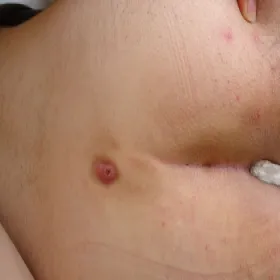 choroba torbiel pilonidalna