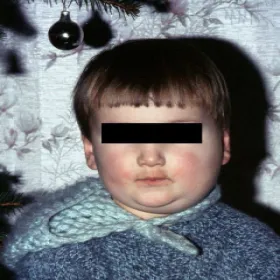 choroba wieku dziecięcego świnka