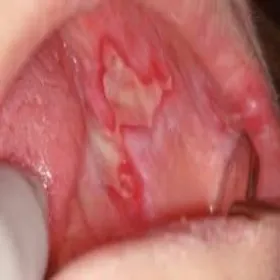 choroby jamy ustnej zdjęcia liszaj czerwony