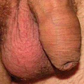 choroby opis zdjęcia stulejka