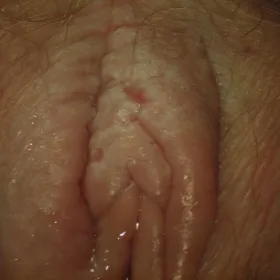 choroby sromu leukoplakia sromu