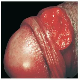 choroby weneryczne u mężczyzn ziarniniak pachwinowy 