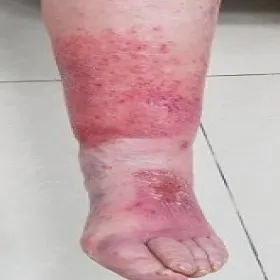 ciemnoczerwona skóra na nodze choroba róża