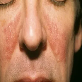 czerwona łuszcząca się skóra na policzkach