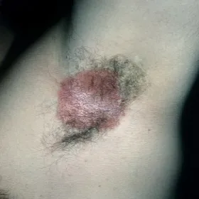 czerwone plamy pod pachami odparzenia