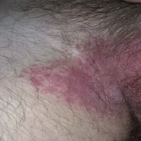 czerwone swędzące plamy w okolicach krocza