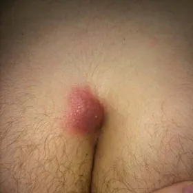 czyrak między pośladkami