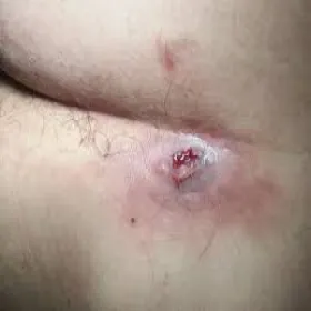 czyrak okolic intymnych