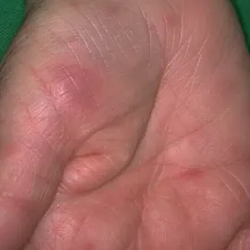 dermatosis neutrophilica febrilis acuta