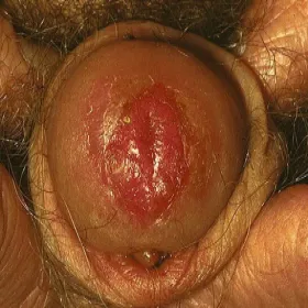 erythroplasia of Queyrat