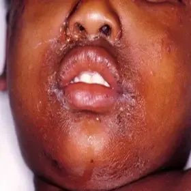 gronkowcowy zespół poparzonej skóry u dziecka