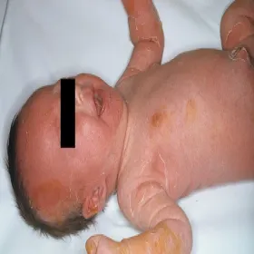 gronkowcowy zespół poparzonej skóry