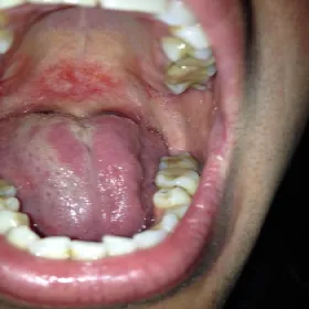 grzybica jamy ustnej u palaczy tytoniu