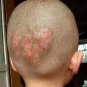 grzybica u dzieci od zwierząt