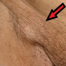 guz w okolicach pachwiny