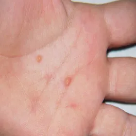 guzki na dłoniach żółtakoziarniniakowatość młodzieńcza 