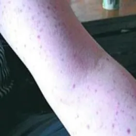 idiopathic thrombocytopenia