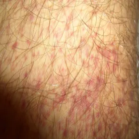 idiopatyczna plamica małopłytkowa