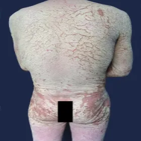 jak wygląda świerzb norweski