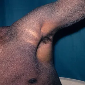 jak wygląda choroba rybia łuska