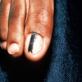 jak wygląda czerniak na paznokciu