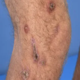 jak wygląda czyrak na nodze