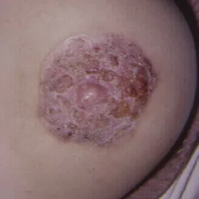 jak wygląda rak sutka zdjęcia