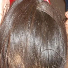 jak wyglądają gnidy na włosach