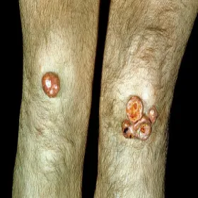 kępki żółte guzkowe na kolanach