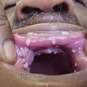 kłykciny kończyste jamy ustnej