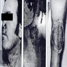 kiła owrzodzenie pierwotne