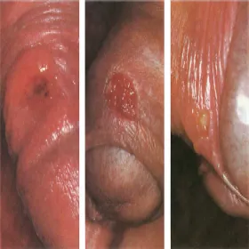  Kiła pierwotna twarde wrzody 