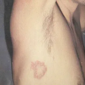 kiła trzeciorzędowa zdjęcie