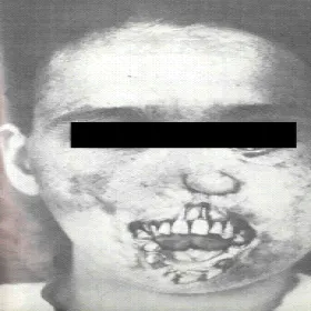 kiła wrodzona deformacja twarzy