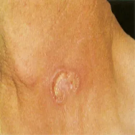 kiła wrzód na szyi