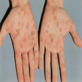 kiła wysypka na dłoniach 