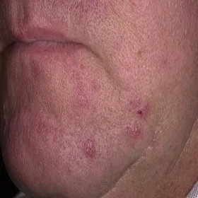 krosty na brodzie figówka