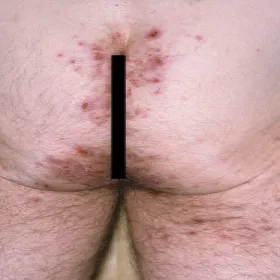 Krosty na pośladkach opryszczkowate zapalenie skóry