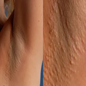 krosty pod pachami choroba Foxa-Fordyce'a