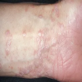 lichen planus