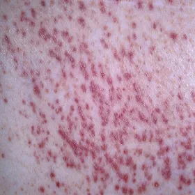 liszaj płaski mieszkowy