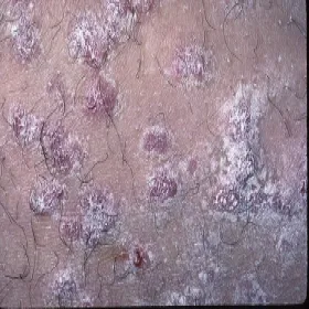 liszaj płaski nadżerkowy