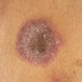 liszaj płaski obrączkowaty